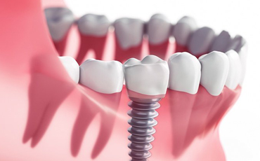 Dental Implants